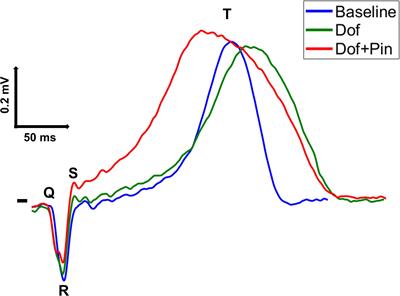 Body Surface Mapping of Ventricular Repolarization Heterogeneity: An Ex-vivo Multiparameter Study